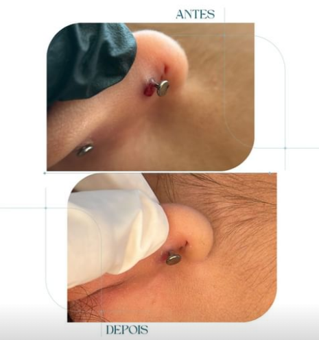 granuloma
