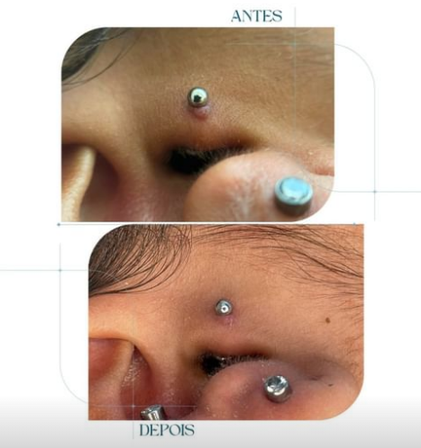 granuloma